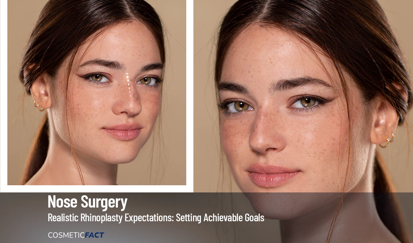 A before-and-after photo of a woman's face, showing her nose before and after a successful rhinoplasty procedure that met her realistic expectations.