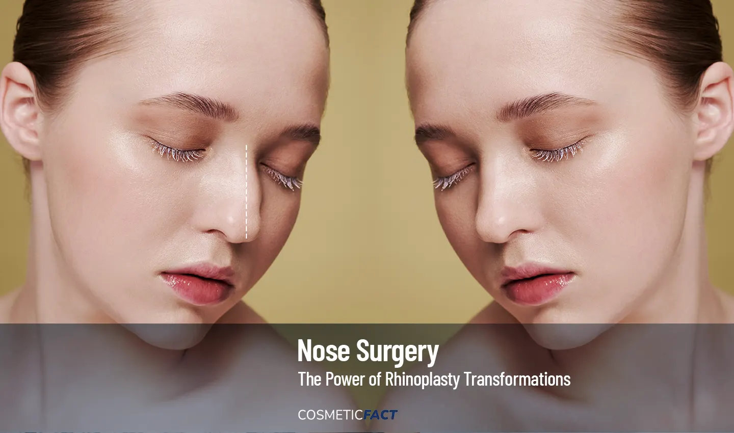 Before and after photo of a woman's nose reshaping transformation, showcasing the powerful impact of rhinoplasty on appearance and confidence