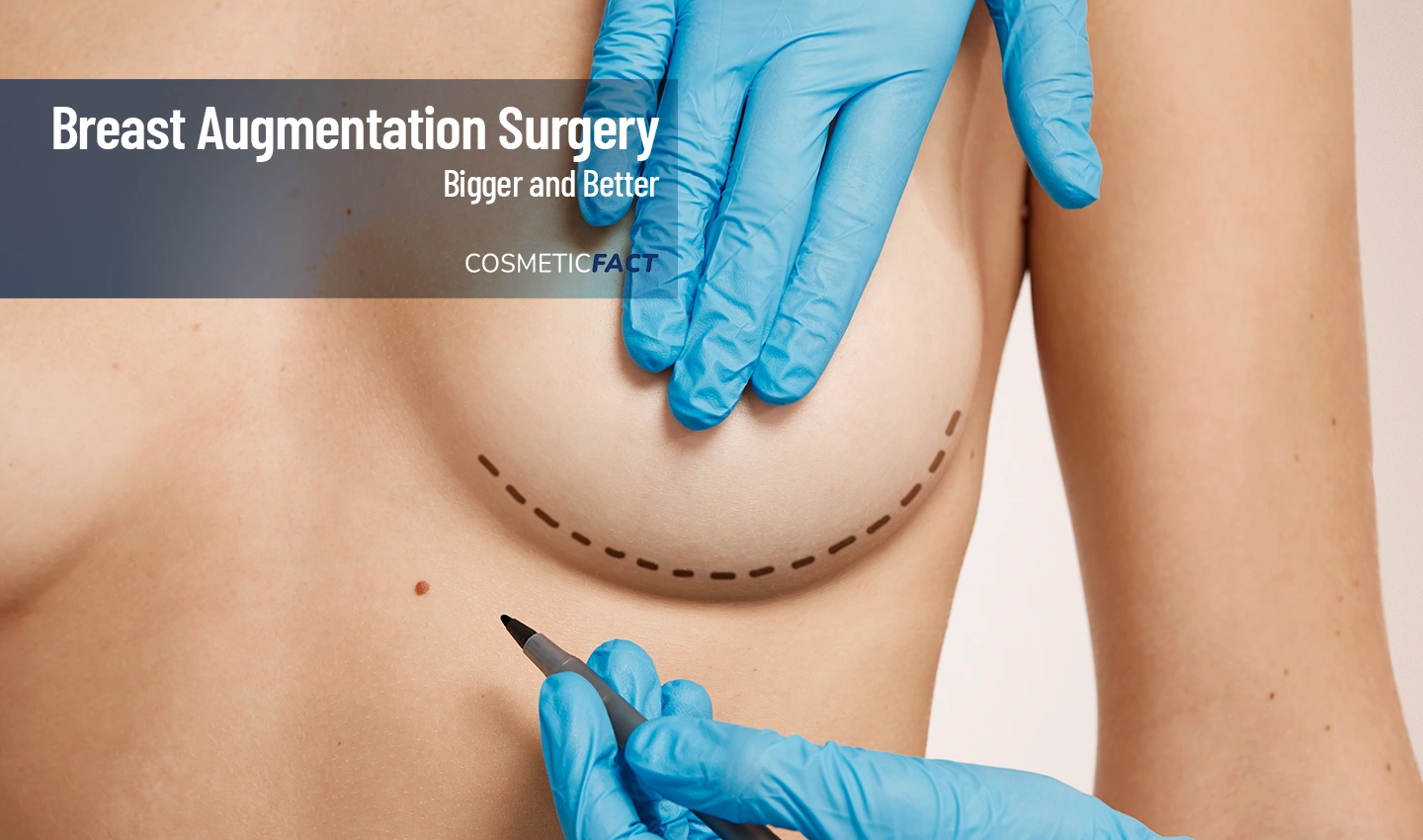 Image of a doctor showing the lines of breast augmentation surgery, highlighting the transformative results that can boost your confidence and enhance your natural beauty