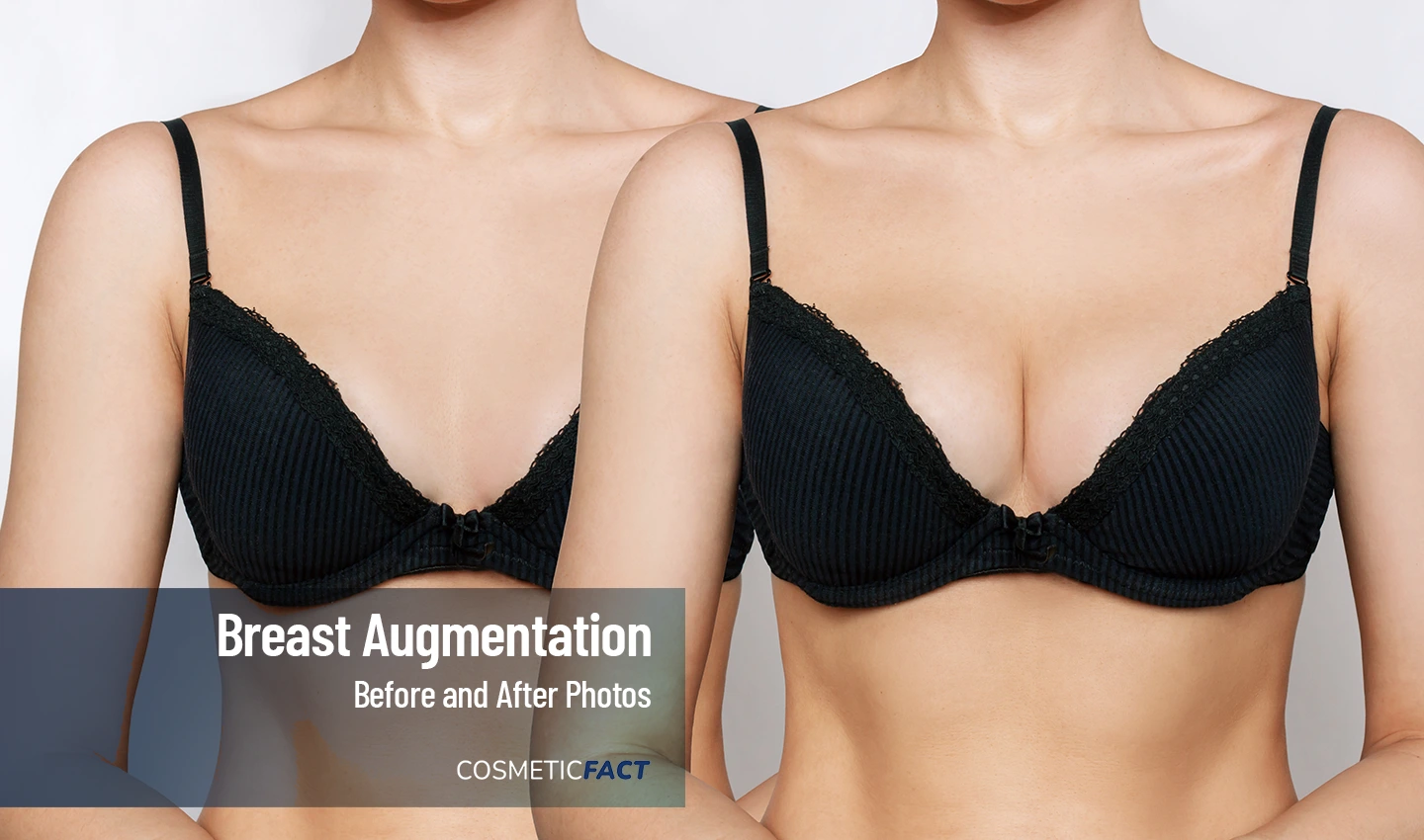 Before-and-after photos of a woman's breasts, illustrating the transformation that breast augmentation surgery can achieve.