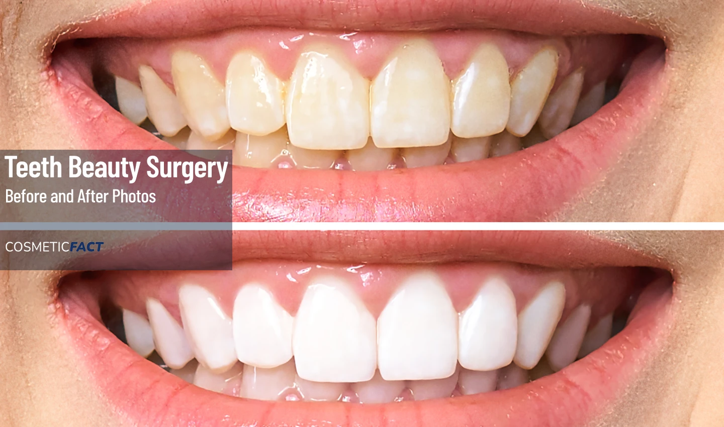 Close-up Smile Makeover Photos showing Before and After Cosmetic Dentistry - a woman's mouth with chipped, yellow teeth transformed into a bright, beautiful smile through cosmetic dental surgery.