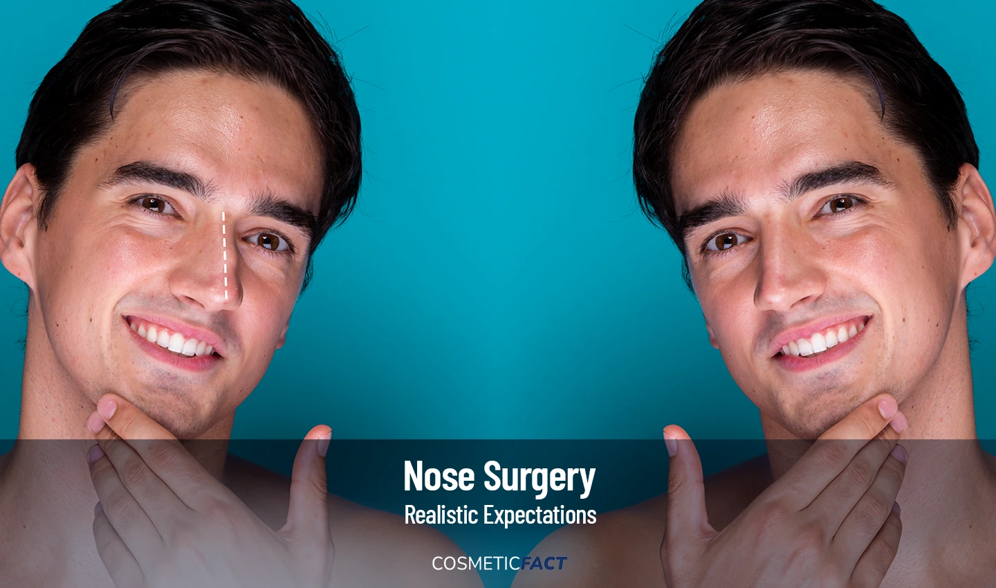 Rhinoplasty Expectations - A before and after photo showing a man with his old nose and new, enhanced nose after a rhinoplasty procedure