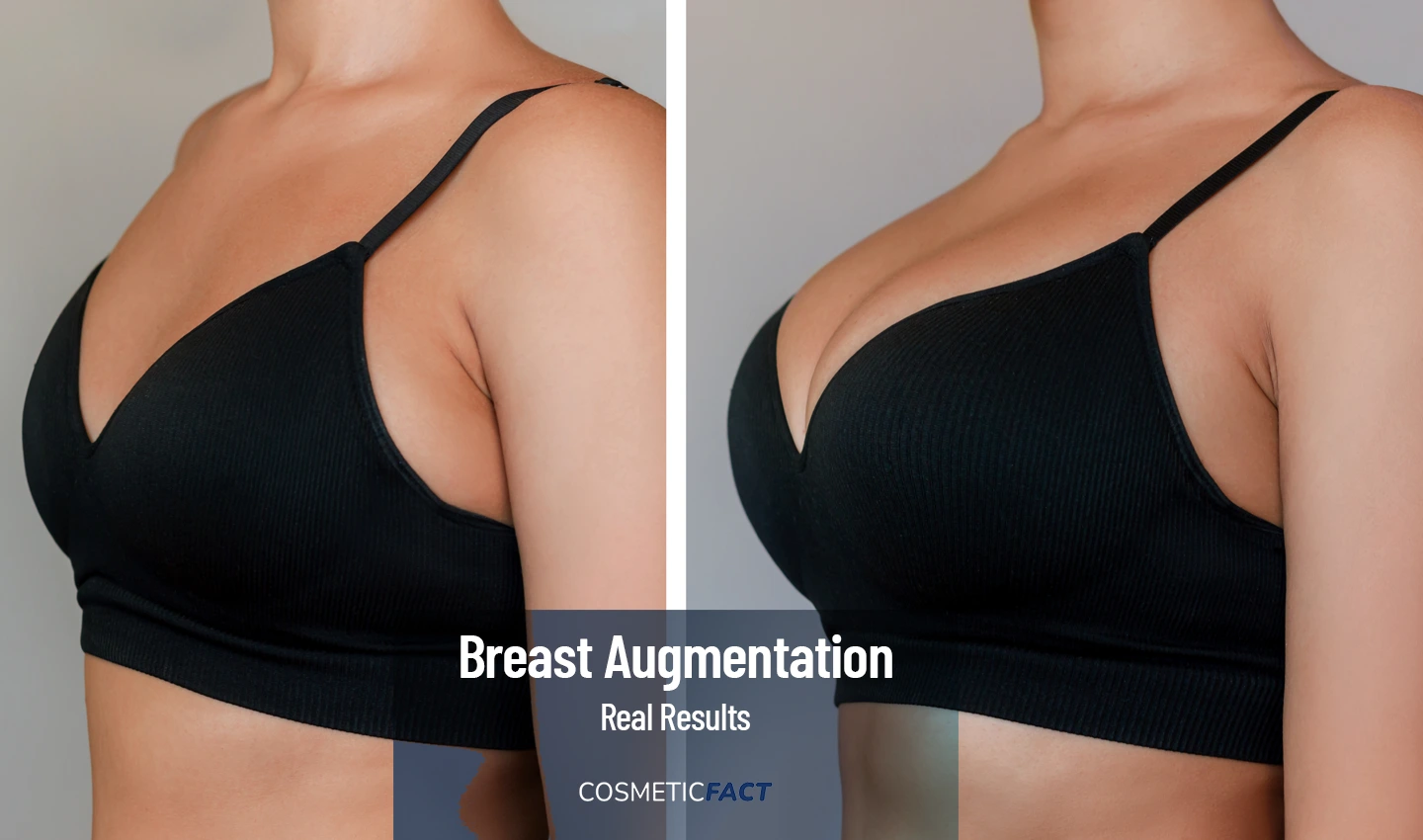 Real Results Breast Augmentation - Before and After Photos of Actual Patient