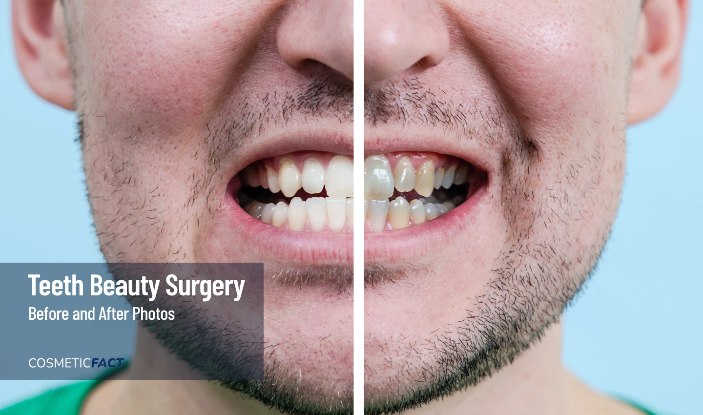 Before-and-after close-up of a man's mouth after cosmetic dental surgery, demonstrating the amazing results of cosmetic dentistry photos.