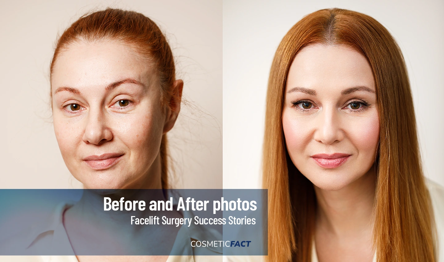 Facelift Success Stories from Real Patients who Share their Before and After Photos