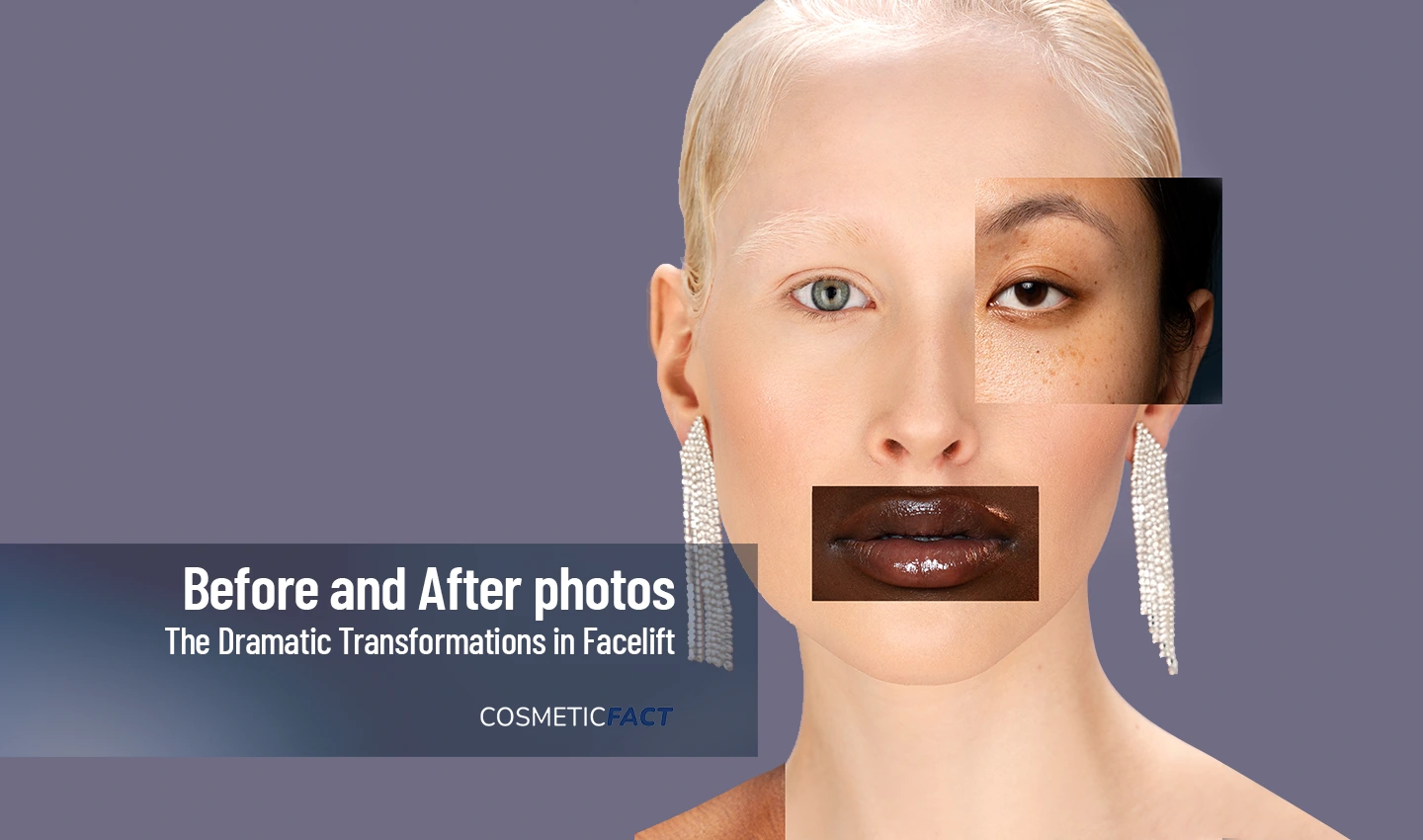 Dramatic Transformations in Facelift Before and After Photos
