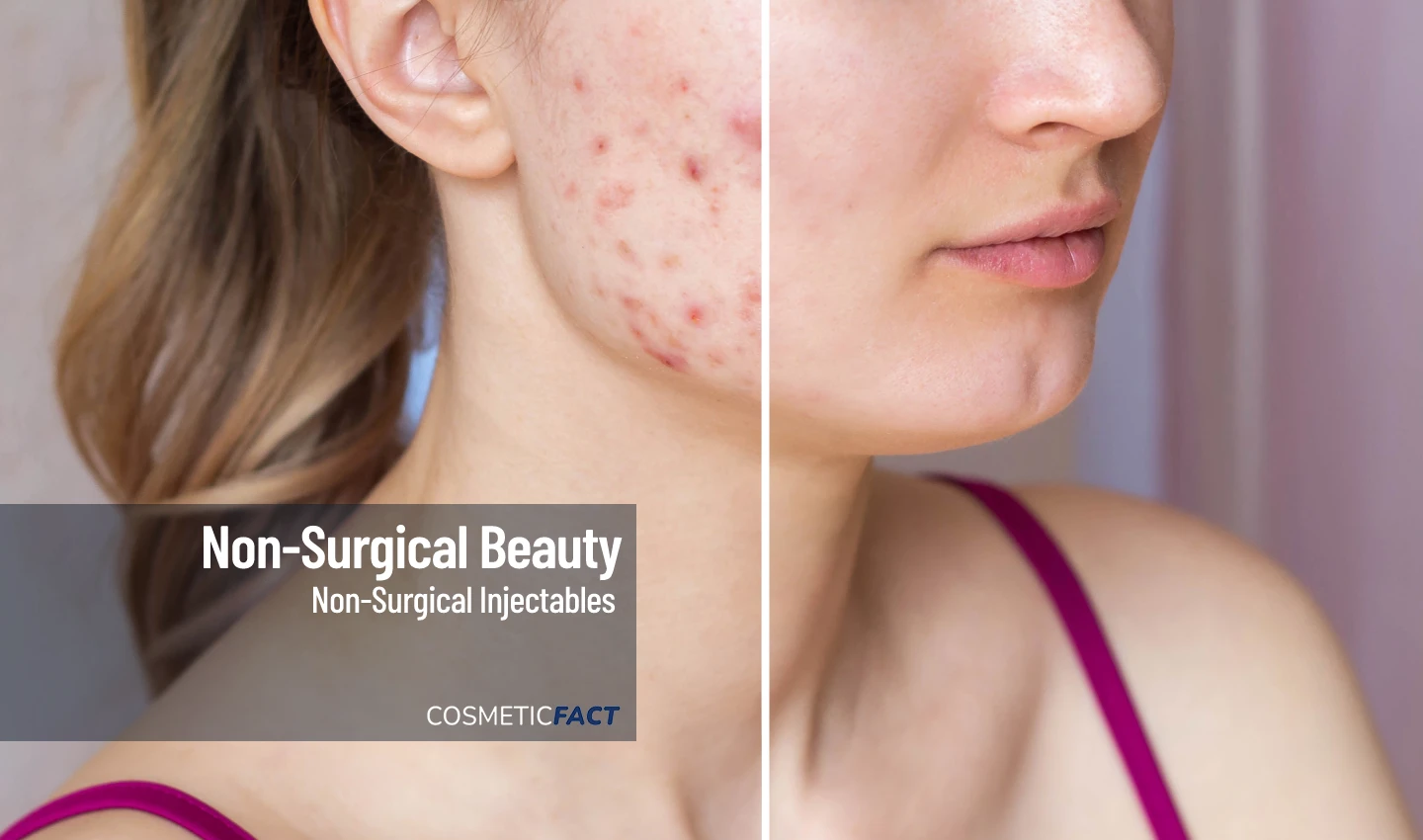 Before-and-after image of a woman's face, with one side displaying severe acne scarring and the other appearing smooth and clear after receiving dermal filler treatment for acne scarring.