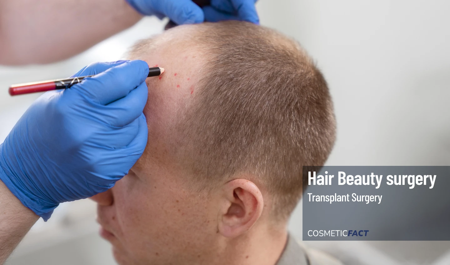 A doctor makes marks on a scalp in preparation for hair implantation, representing hair transplant surgery.