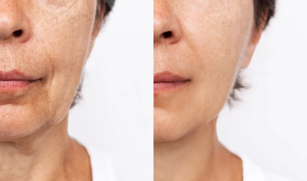 An image split in half, featuring two shots of the same woman. One shot shows sagging skin around the lips, chin, and cheeks, while the other shows a more youthful, firm appearance in those areas. The image emphasizes the effects of non-surgical solutions for sagging skin and the importance of achieving a more youthful appearance.