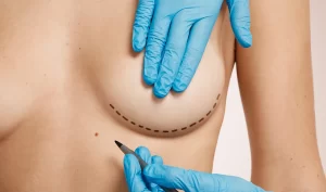 Image of a doctor showing the lines of breast augmentation surgery, highlighting the transformative results that can boost your confidence and enhance your natural beauty