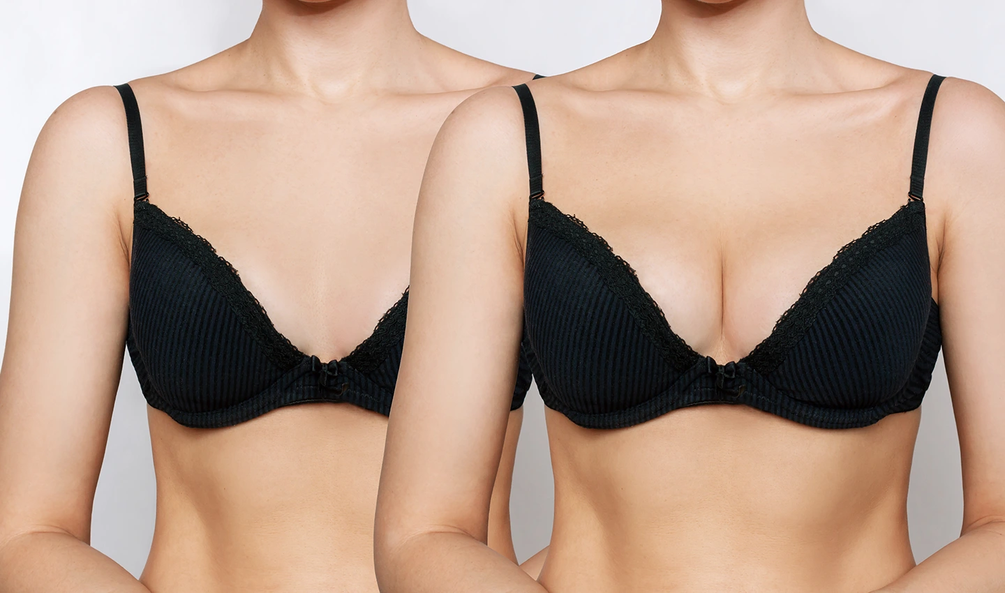 Before-and-after photos of a woman's breasts, illustrating the transformation that breast augmentation surgery can achieve.