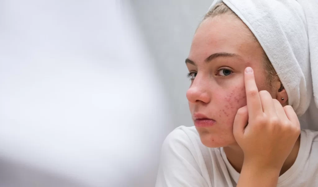 Before and after photo of a girl's face with acne, showing the effectiveness of acne treatments for achieving a flawless complexion.