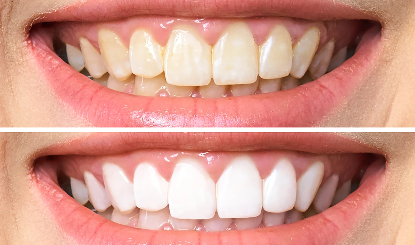 Close-up Smile Makeover Photos showing Before and After Cosmetic Dentistry - a woman's mouth with chipped, yellow teeth transformed into a bright, beautiful smile through cosmetic dental surgery.