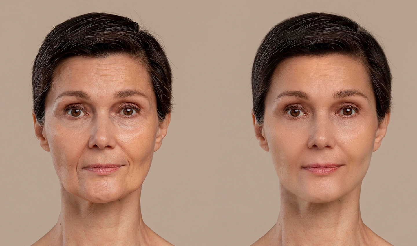 Facelift Before and After Photos - Analyzing Results and Setting Realistic Expectations
