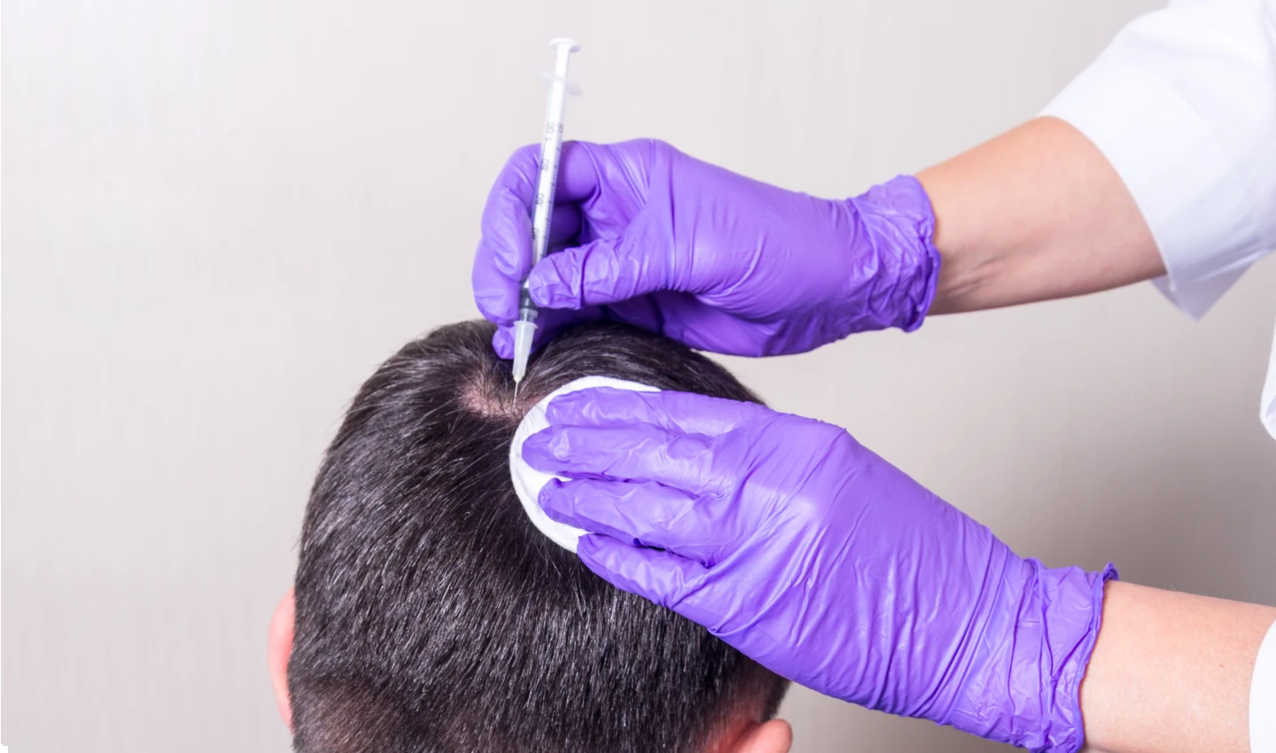 A doctor performing platelet-rich plasma therapy on a patient's scalp to stimulate hair growth and improve the overall appearance of the hair for hair transplant revision purposes.