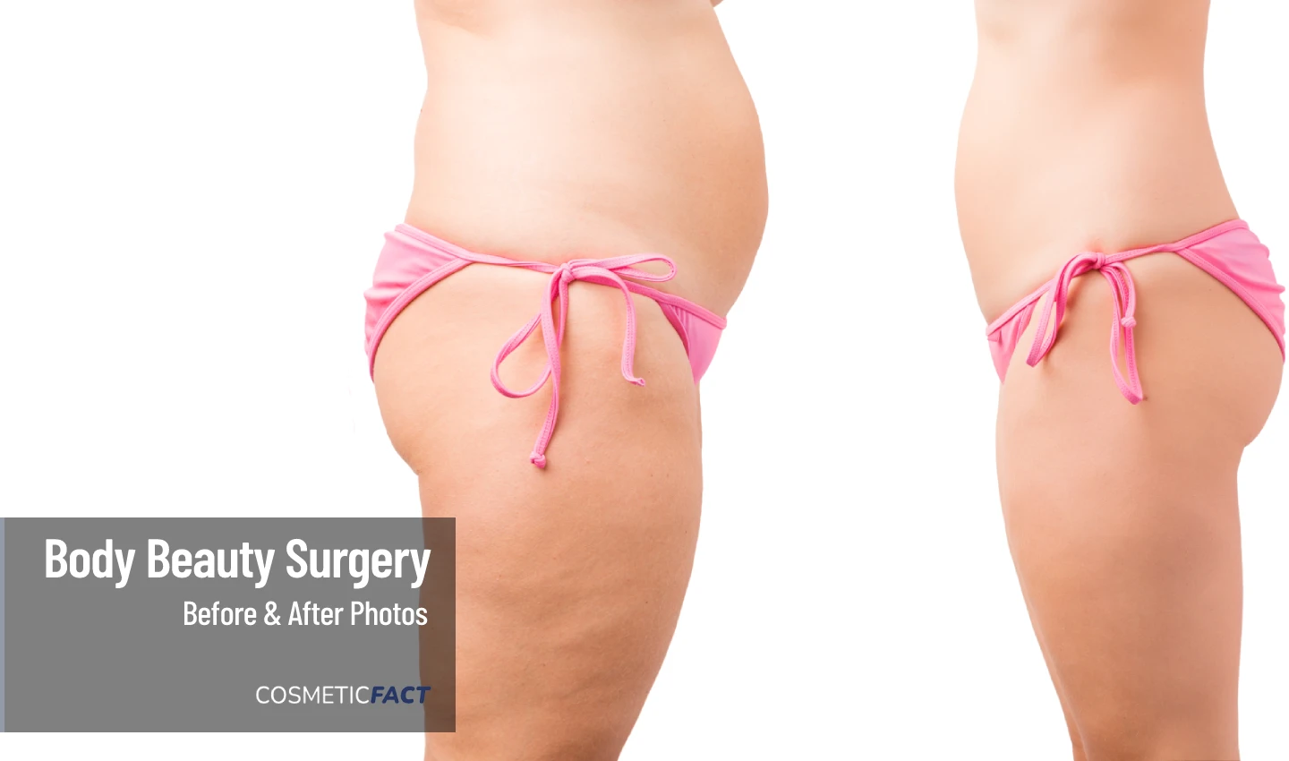 Before and After Photos of Liposuction Surgery on a Mature Woman - witness the stunning transformation with these Liposuction Surgery Photos showcasing the effects of removing excess fat to create a more sculpted and toned physique.