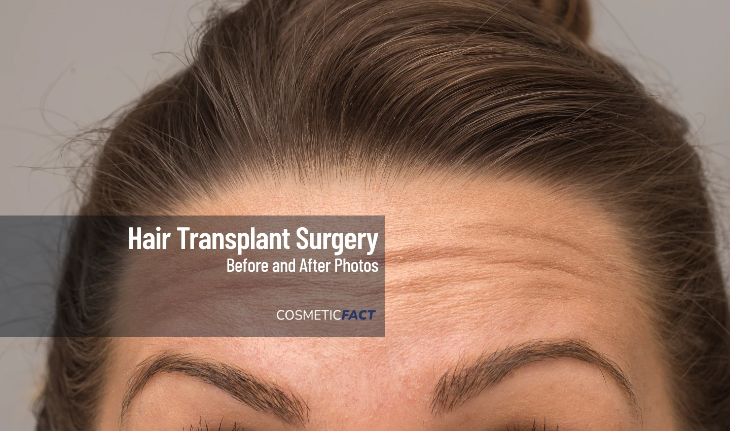 Woman looking at her hairline in the mirror after undergoing successful hairline reconstruction, with a noticeable improvement in fullness and evenness.