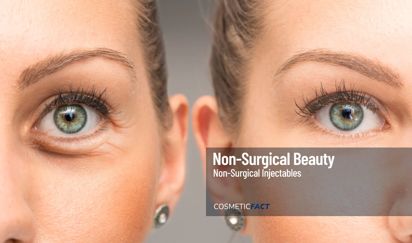 Before and after image of a woman's eye, demonstrating the effects of dermal fillers for under eye hollows treatment.