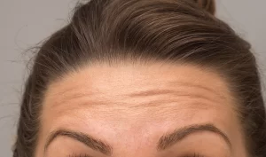 Woman looking at her hairline in the mirror after undergoing successful hairline reconstruction, with a noticeable improvement in fullness and evenness.