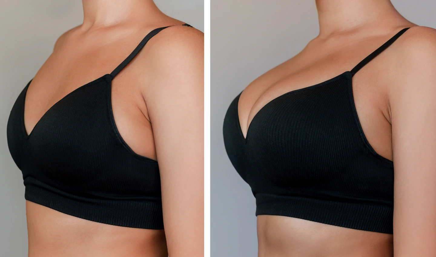 Real Results Breast Augmentation - Before and After Photos of Actual Patient