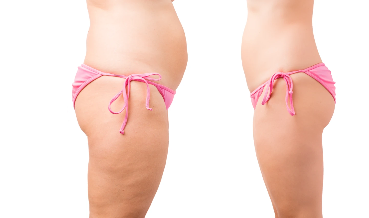 Before and After Photos of Liposuction Surgery on a Mature Woman - witness the stunning transformation with these Liposuction Surgery Photos showcasing the effects of removing excess fat to create a more sculpted and toned physique.