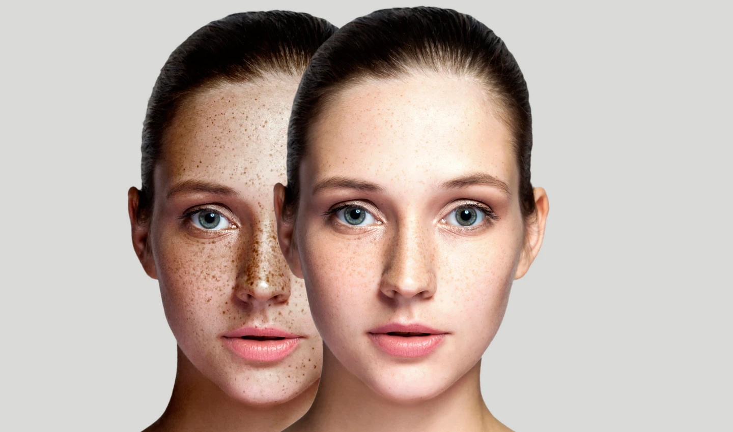 Before and after shots of a young woman's complexion. In the "before" shot, she has dark spots on her face. In the "after" shot, her complexion is clear and even-toned.