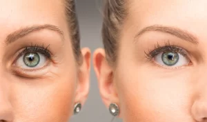 Before and after image of a woman's eye, demonstrating the effects of dermal fillers for under eye hollows treatment.