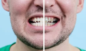 Before-and-after close-up of a man's mouth after cosmetic dental surgery, demonstrating the amazing results of cosmetic dentistry photos.