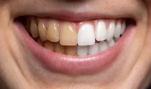 A close-up view of teeth before and after combining teeth whitening and straightening procedures, demonstrating the benefits of these cosmetic dental treatments.