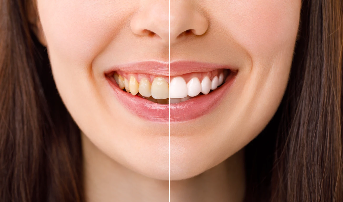 A comparison photo showing the transformation of a patient's smile before and after non-invasive cosmetic dentistry treatments, highlighting the improvement in teeth appearance from old to beautiful white teeth.