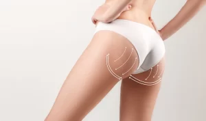 Image of a woman's buttocks with before surgery lines showing the places that were lifted during a butt lift procedure.