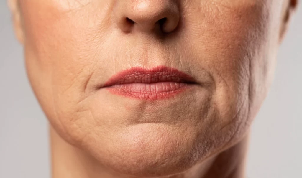 The lip, chin, and jawline of a middle-aged woman with sagging skin. The image highlights the natural effects of aging on skin elasticity.