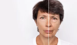 Choosing a Facelift Surgeon - The Importance of Before and After Photos