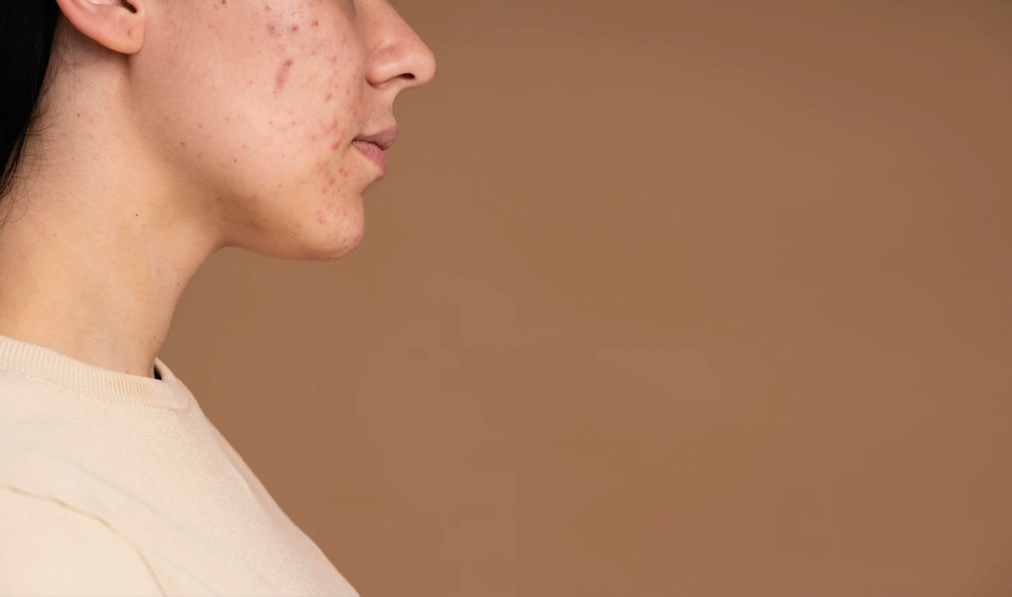 A girl's face with acne, highlighting the importance of a holistic approach to acne treatment.