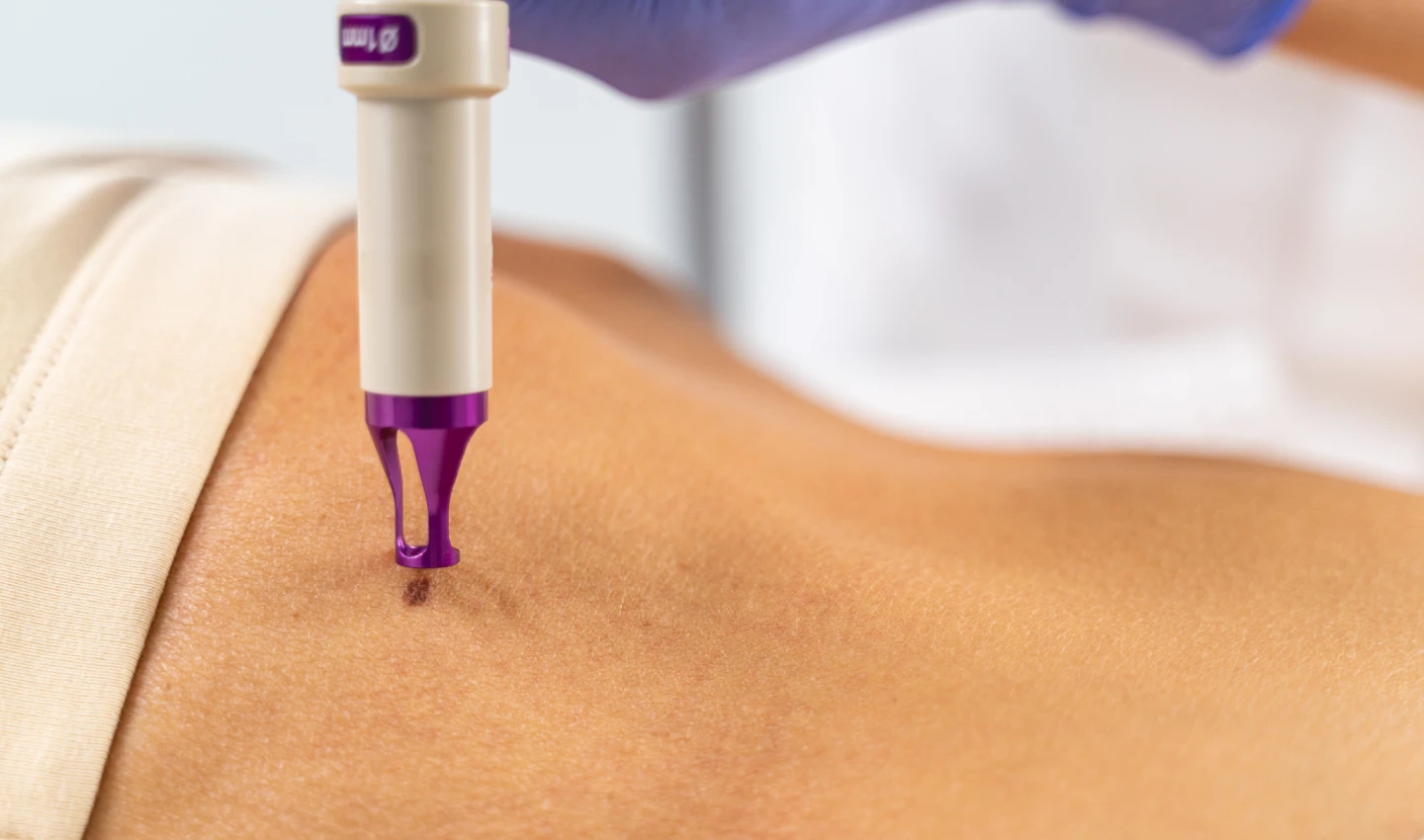 Laser scar reduction head emitting beams of light onto the skin.