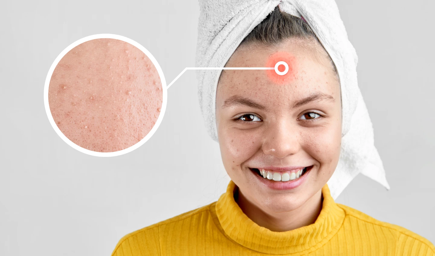 A girl with acne-prone skin pointing to a spot on her face, representing the different types of acne and their causes.