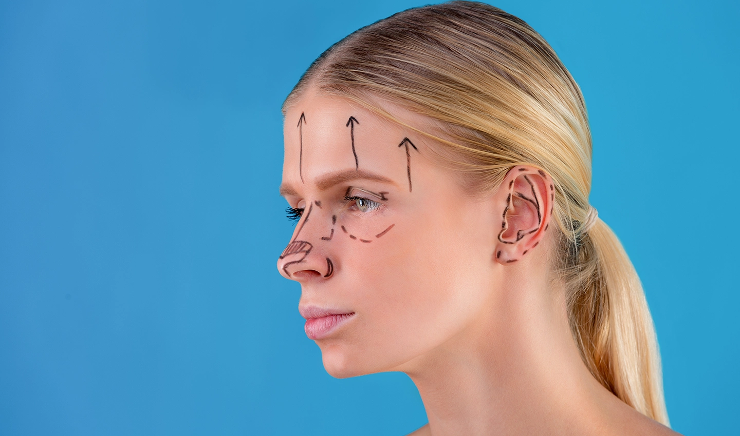 A woman preparing for facelift surgery with black markers on her face.