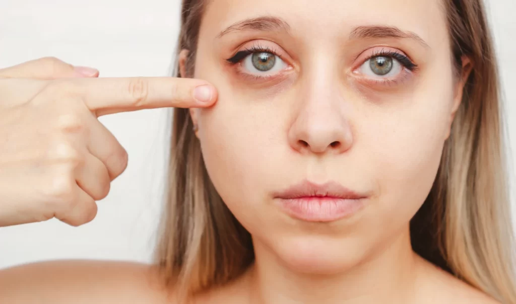 Before and after image showcasing the results of non-surgical dark circle reduction solutions on a woman with darkness under her eyes.