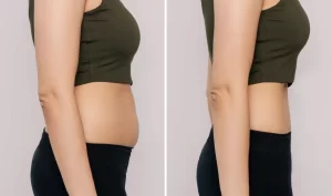 Before and after photo of a woman's abdomen, showing the results of tummy tuck surgery.