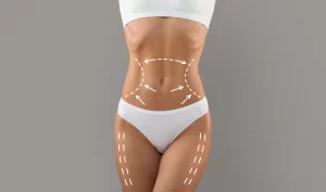 Woman with visible lines on her body indicating non-surgical body contouring.