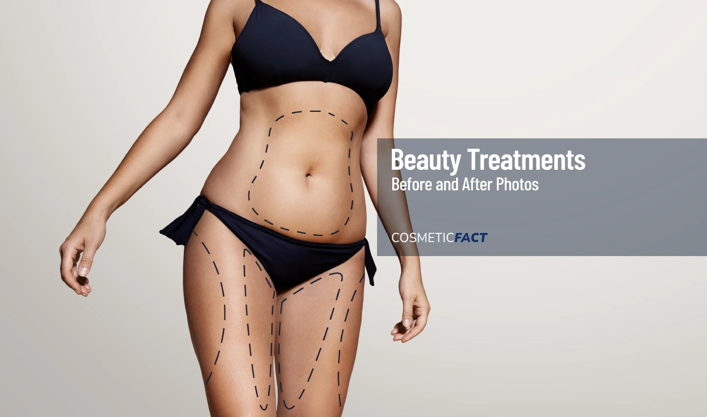 Image of a woman's body with surgical lines representing body contouring surgery, showcasing the transformative power of the procedure.