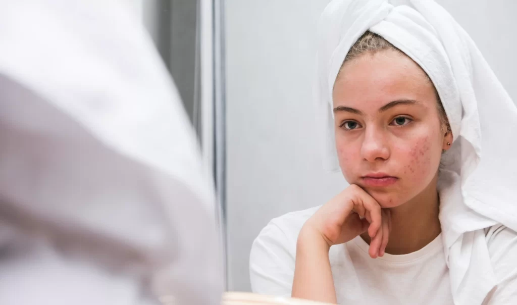 Sad woman looking in the mirror holding a bottle of Acne-Prone Skin Moisturiser. Get hydrated skin without clogging pores.