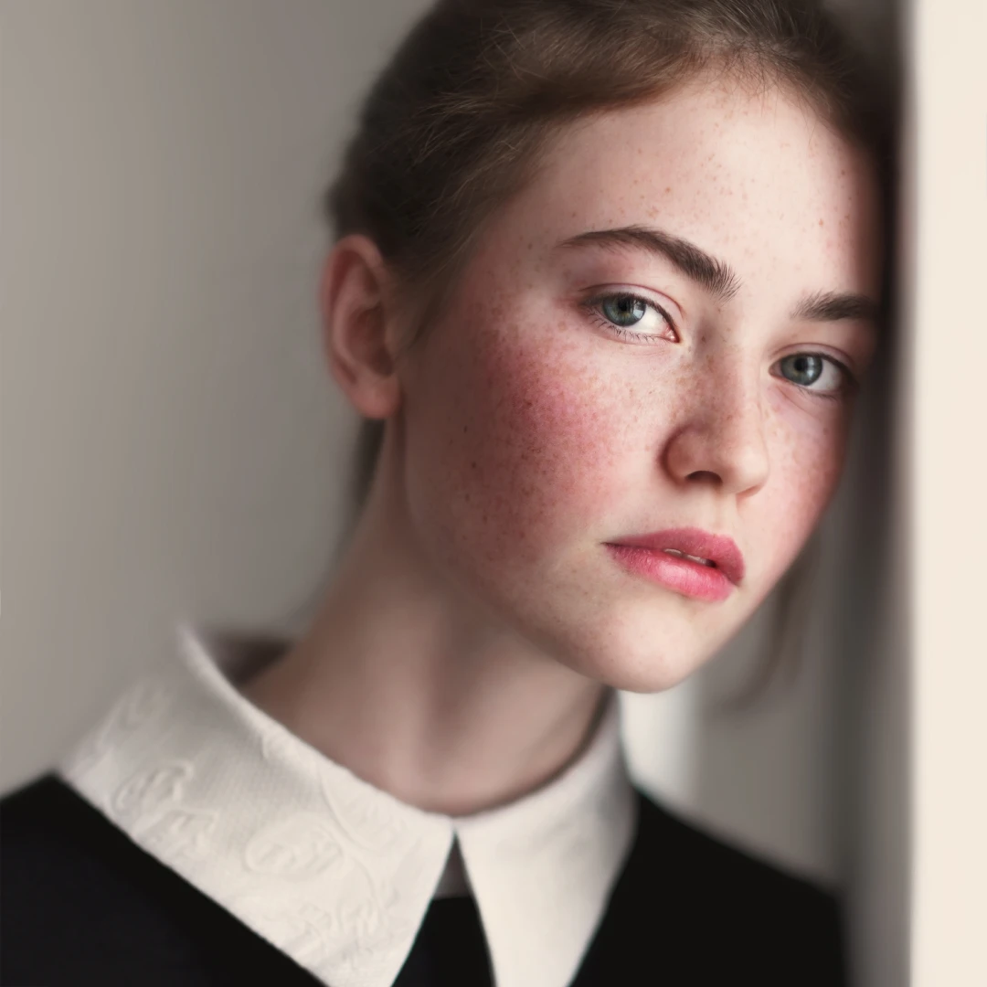 A young woman portrait with acne on her face