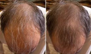 A comparison of before and after photos for non-surgical hair regrowth.