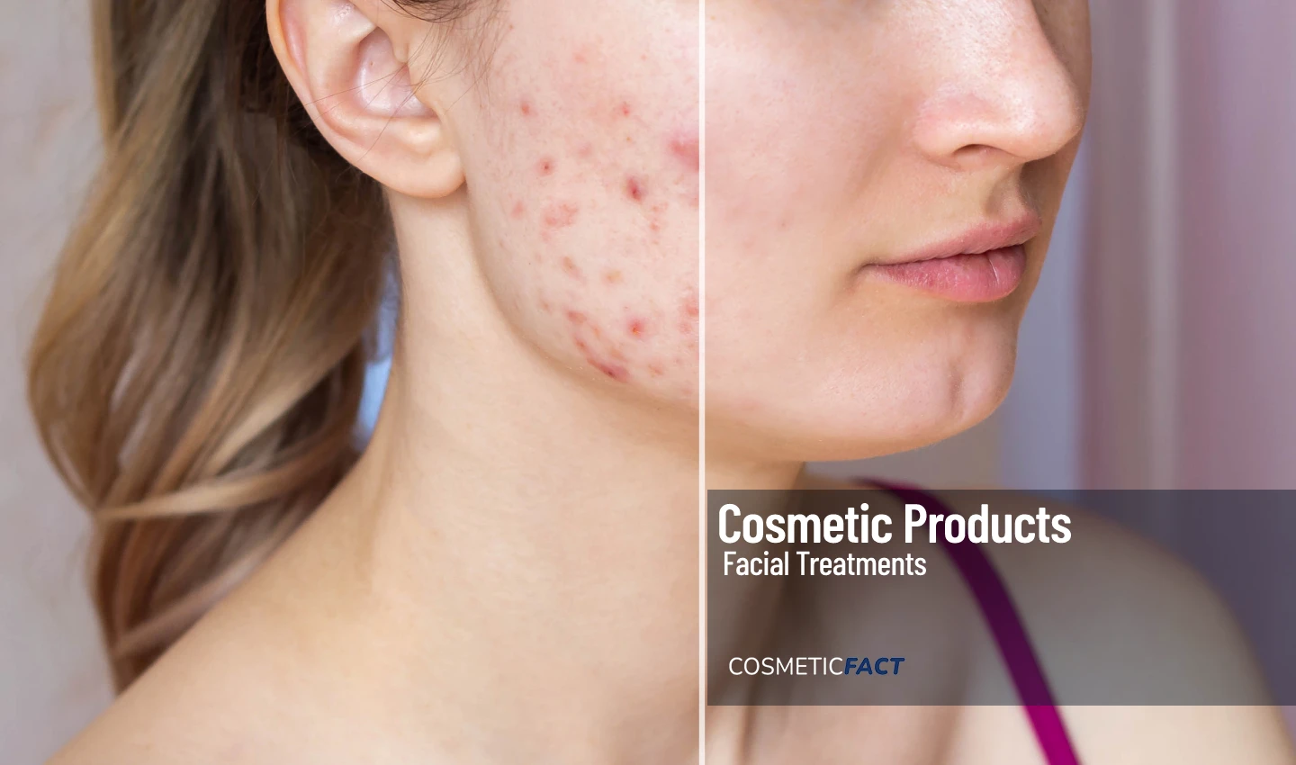 Cropped shot of a young woman's face before and after acne treatment, focusing on eliminating acne scars.