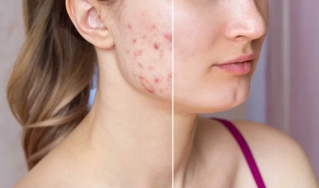 Cropped shot of a young woman's face before and after acne treatment, focusing on eliminating acne scars.