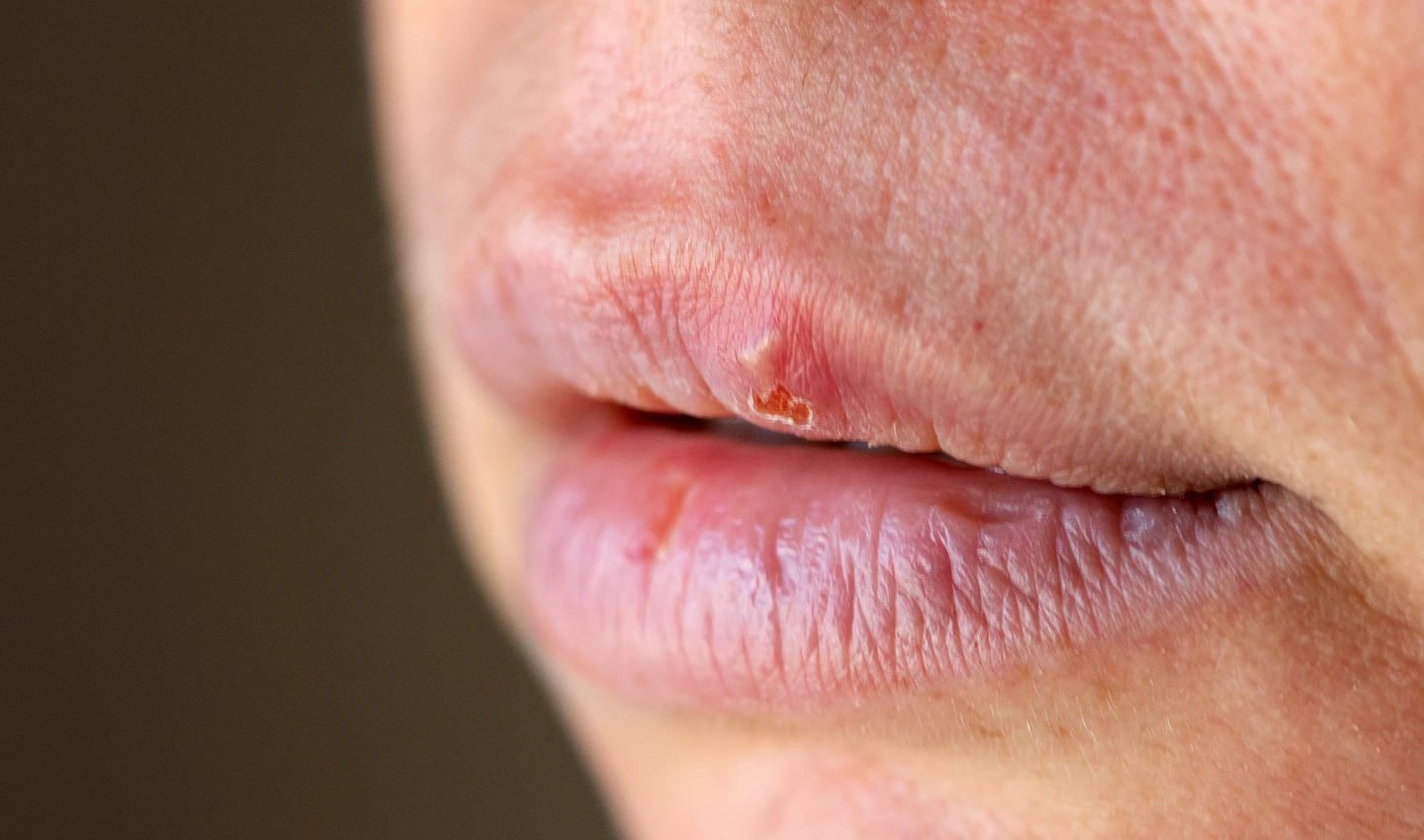 A close-up shot of a dried lip, exemplifying lip dryness, a common issue addressed in the article