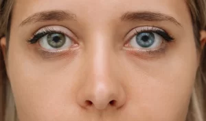 Under-Eye Circles: Close-up of a woman with noticeable dark circles under her eyes