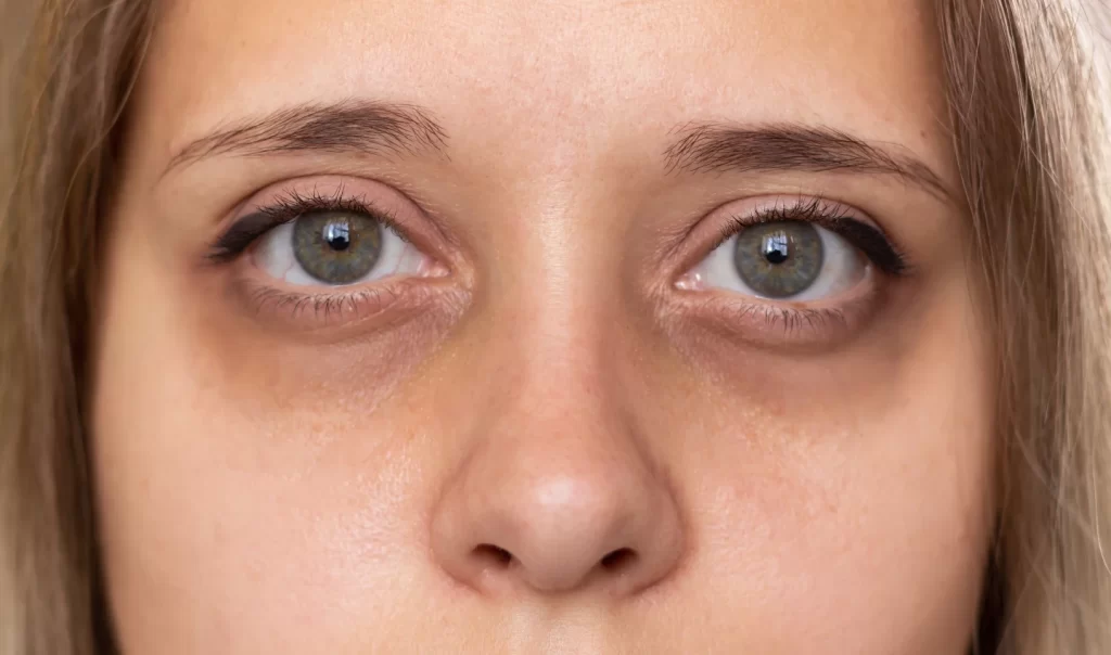 Woman's radiant eyes contrasted with her dark under-eye circles