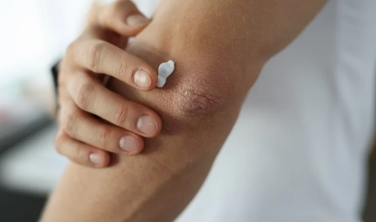 Image of a woman's elbows affected by eczema as she applies soothing cream.